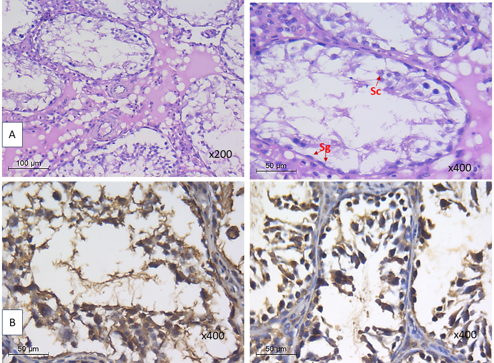 High fat diest fed group showing. (A) decrease tubular
diameter, epithelial height and low Jhonson score. (B) with increase interstitial
space as well as increased HMGB-1 and NLRP3. Sg: spermatogonia, Sc: spermatocyte,
s: spermatozoa.