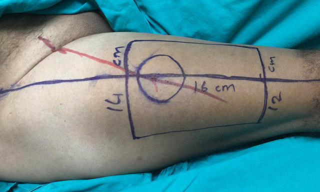 Determination of Antero Lateral Thigh flap perforators with 
doppler ultrasonography and marking on the skin.