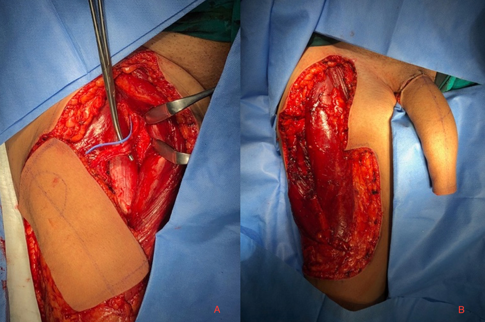 Elevating the rectus femoris and sartorius muscles. (A) Flap and accompanying vascular structures. (B) 
Rectus femoris and sartorius muscles.