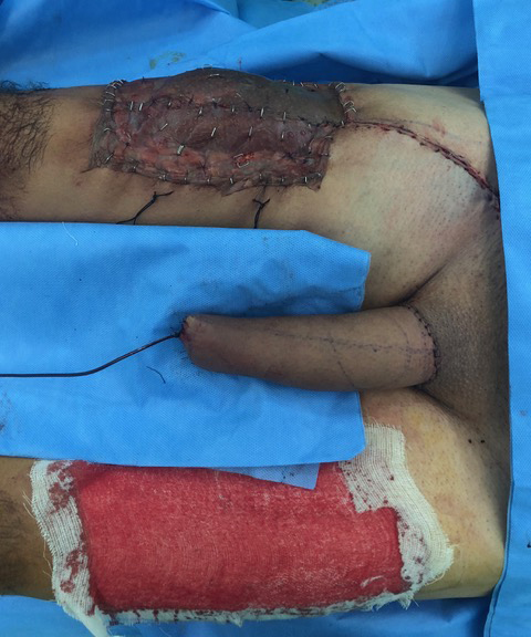 Fixation the thigh flap in the shape of “tube in tube” to the 
recipient area.