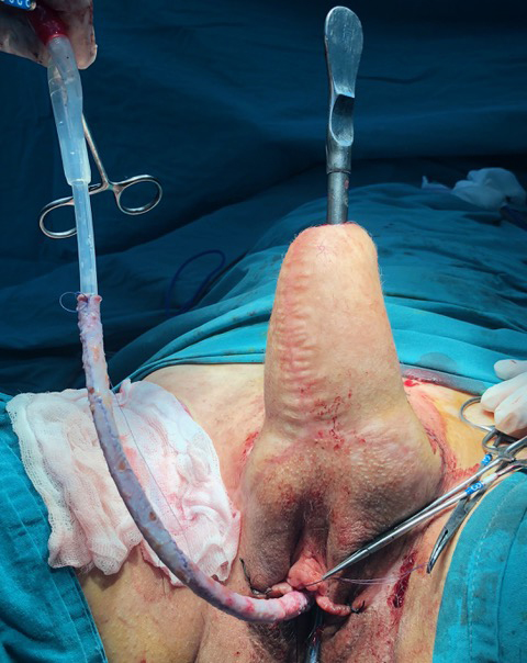 Tubularization of the graft on the 18ch Foley catheter.