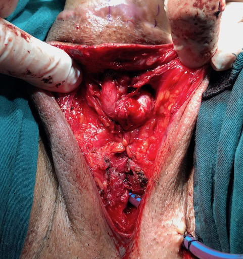 Fixation of the clitoral hood onto the neourethral anastomosis.