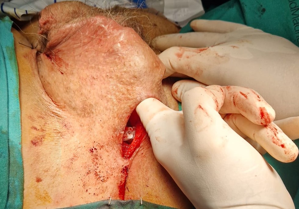 Desarrollo digital del bolsillo de dartos desde la incision
perineal para colocar la bomba-reservorio.