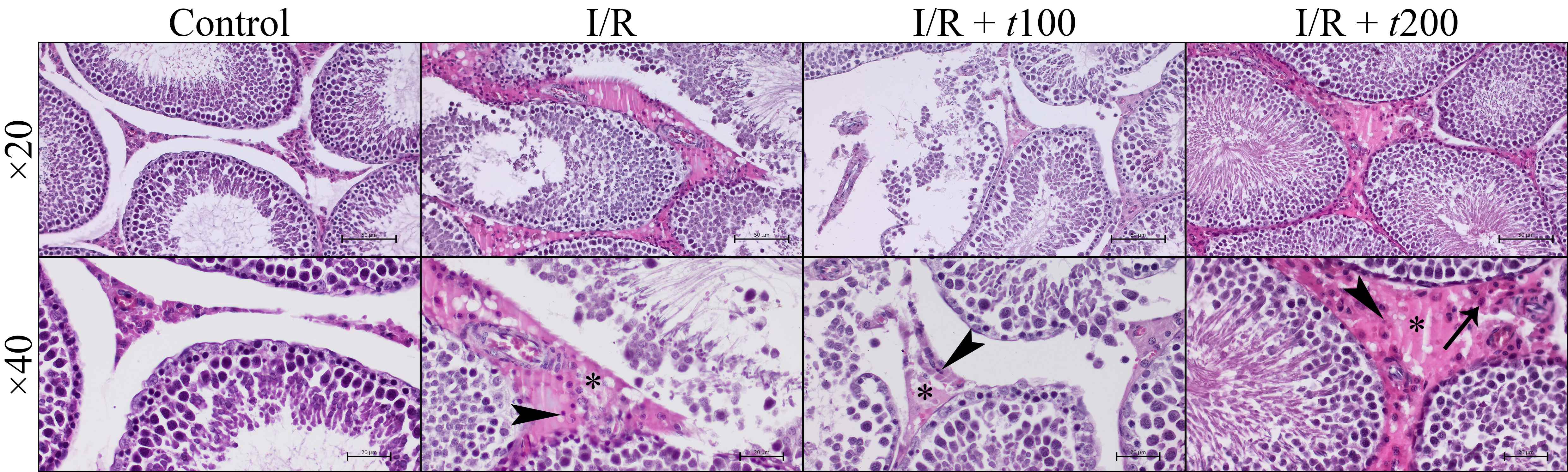 Representative high and low magnified histopathological
micrographs from Control, I/R, I/R + t100, I/R + t200 groups.
There were severe pathological changes in testicular tissue in I/R group such as
peritubular edema and hemorrhage (asterisk) with large numbers of lymphocytes
(arrow) in intertubulary tissue, and pyknosis in intertubular Leydig cells
(arrowhead) and desquamation of germinal epithelium within the tubular lumen.
Pathological severity in I/R + t100 group was almost similar to the I/R
group. Although intertubulary edema and hemorrhage, nucleus pyknosis in Leydig
cells and germinal epithelium were obviously detectable in I/R + t100,
I/R + t200 groups, the severity in tubular structure alleviated
significantly, mainly in higher dose administered group. Staining: Hematoxylin
and Eosin, Bar: 50 µm in ×20 micrographs, 20
µm in ×40 micrographs. I/R: Ischemia reperfusion.