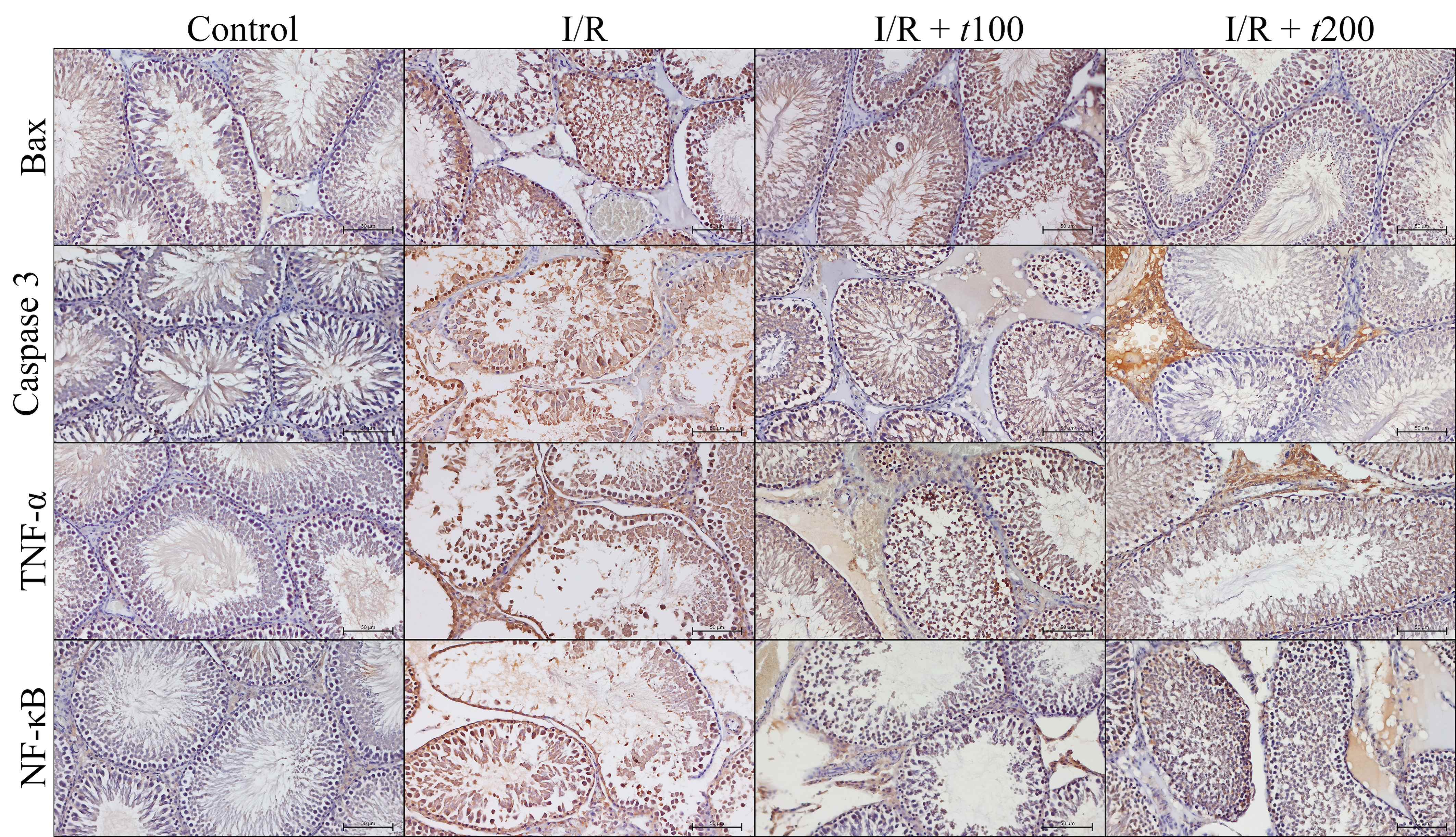 Representative immunohistochemistry micrographs of Bax, Caspase 3,
TNF-α and NF-κB in Control, I/R, I/R + t100, I/R +
t200 groups. Brown color on tissue sections indicate existence of the
protein of interest. Samples were counterstained to distinguish DAB observed
immunopositive regions from the rest of the testicle tissue. The immunodensity of
interest protein was obtained through comparing DAB chromogen positive are with
total tissue sections. Counterstaining: Hematoxylin. Bar: 50 µm.
I/R: Ischemia reperfusion; Bax: Bcl-2 associated X; TNF-α: Tumor
necrosis factor-alpha; NF-κB: Nuclear factor kappa-light-chain-enhancer
of activated B cells.