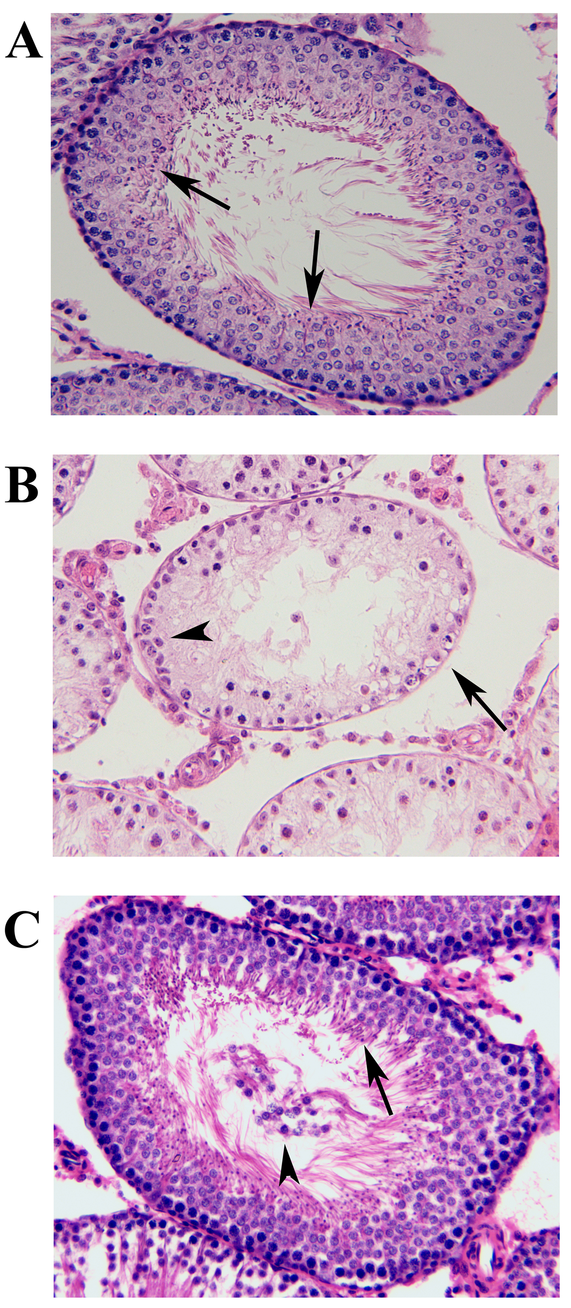 Representative H&E-stained
testicular sections from control, testicular ischemia-reperfusion, and
safranal-treated groups. (A) Both the contralateral testes from the three groups
and the ipsilateral testes from the control group showed normal seminiferous
tubular outline, a multilayer structure of germinal epithelium, a substantial
quantity of mature sperms (↑), and an open seminiferous tube lumen.
(B) It was found that seminiferous tubules (↑) appeared shrunken in
the ipsilateral testes from the testicular ischemia-reperfusion group. The
multilayer structure of germinal epithelium (▲) was lost and the
seminiferous tubular lumen became empty of sperm. (C) Seminiferous tubules of
ipsilateral testes from the safranal-treated group were restored to almost normal
histological architecture. The seminiferous tubular lumen was full of mature
sperms (↑). However, some exfoliated necrotic cells (▲) were
observed in the center of the seminiferous tubule. These disordered sloughed
germinal cells clogged the seminiferous tubule easily. Magnification ×200 for all images; H&E: hematoxylin-eosin.