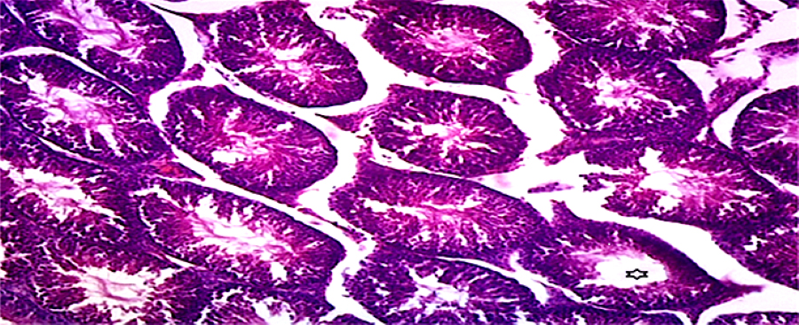 Histopathological image of group B testicular tissue treated
with 20 mg/kg tramadol only (H&E), ×100. The testis
photomicrograph reveals the intricate histoarchitecture of the seminiferous
tubules, which are the sites of sperm production. Within each seminiferous
tubule, a pool of dividing spermatogonia can be observed near the basement
membrane, marking the initial stage of spermatogenesis. These germ cells
progressively mature as they move towards the lumen of the tubule, where they
normally develop into fully formed spermatozoa. The interstitial spaces between
the seminiferous tubules are populated with Leydig cells, which are crucial for
the production of testosterone. These cells are distributed in the connective
tissue surrounding the tubules, forming a supportive framework for the
seminiferous epithelium. However, the photomicrograph indicates a significant
pathological finding: a marked loss or degradation of spermatozoa within the
lumen of the seminiferous tubules, as highlighted by the starred area. This
reduction in the number of mature sperm cells suggests a disruption in the normal
process of spermatogenesis. The observed degradation may be indicative of
testicular damage.