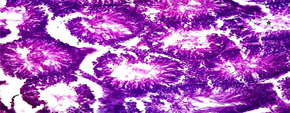 Histopathological image of group C testicular tissue treated
with 20 mg/kg tramadol + 25 μg vitamin D3 (H&E),
×100. The testis photomicrograph illustrates the detailed
histoarchitecture of the seminiferous tubules and surrounding interstitial
tissue. Each seminiferous tubule displays a layered arrangement of germ cells at
various stages of spermatogenesis, beginning with spermatogonia near the basement
membrane and progressing towards the lumen, where mature spermatozoa are
typically found. The seminiferous tubules are lined with Sertoli cells that
support the development of these germ cells. In the interstitial spaces between
the tubules, clusters of Leydig cells are observed, responsible for testosterone
production. However, a marked degradation of spermatozoa is evident in the lumen
of the seminiferous tubules, as highlighted by the starred area. This degradation
suggests a disruption in the process of spermatogenesis, possibly indicative of
testicular damage or dysfunction. The loss of spermatozoa in tubules points to a
reduction in the number of mature sperm cells. The interstitial cells, though
still present, appear to be less densely arranged.