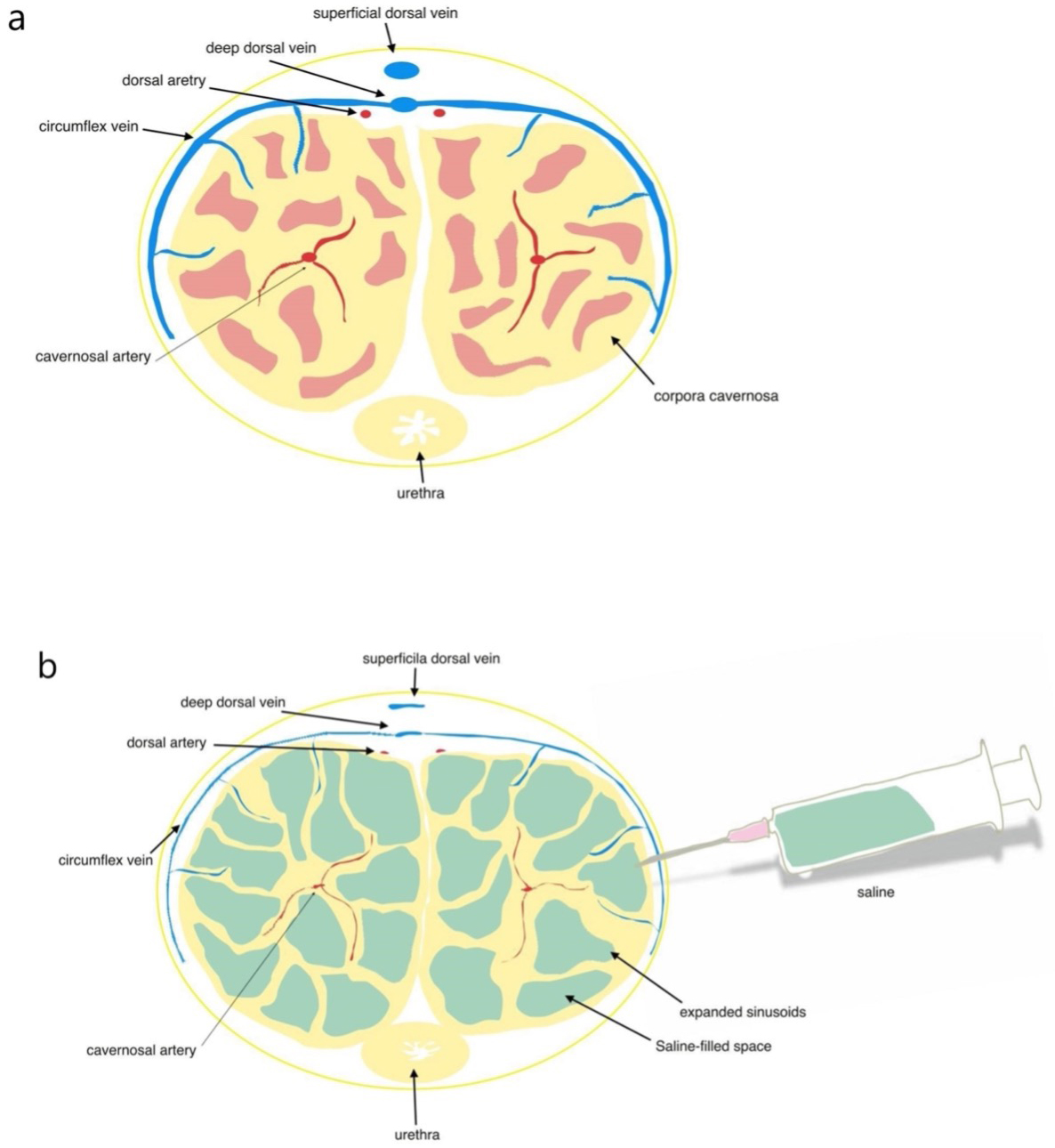 Schematic representation of vascular changes in the
penis without (a) and with (b) Artificial Erection. (a) Flaccid penile anatomy.
(b) Saline injected penile figure, expanded cavernosal sinusoids, and compressed
arterial and venous system.