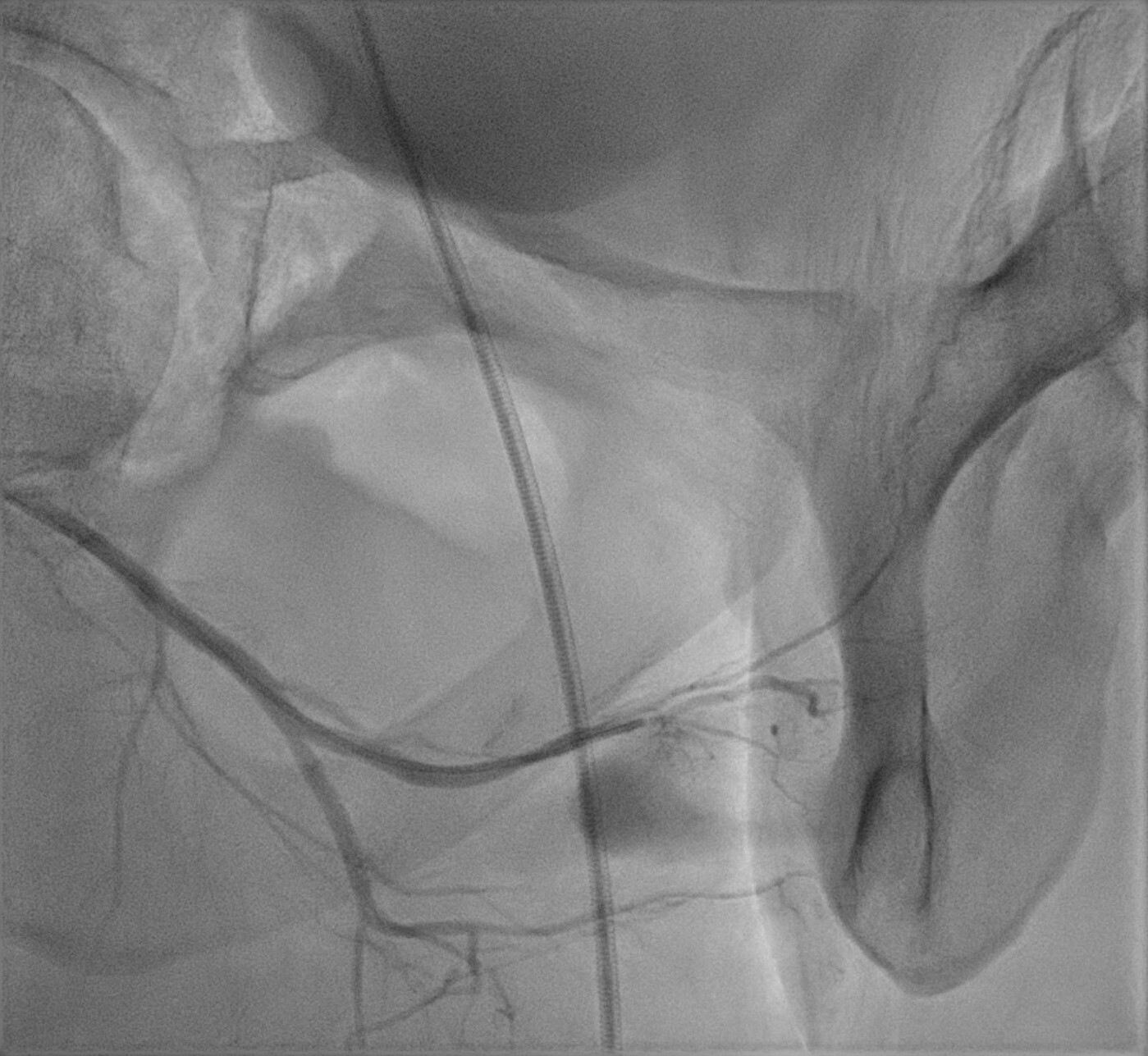 Initial non-permanent embolization with
Spongostan® of fistula between the right internal pudendal artery
and the right corpus cavernosum.