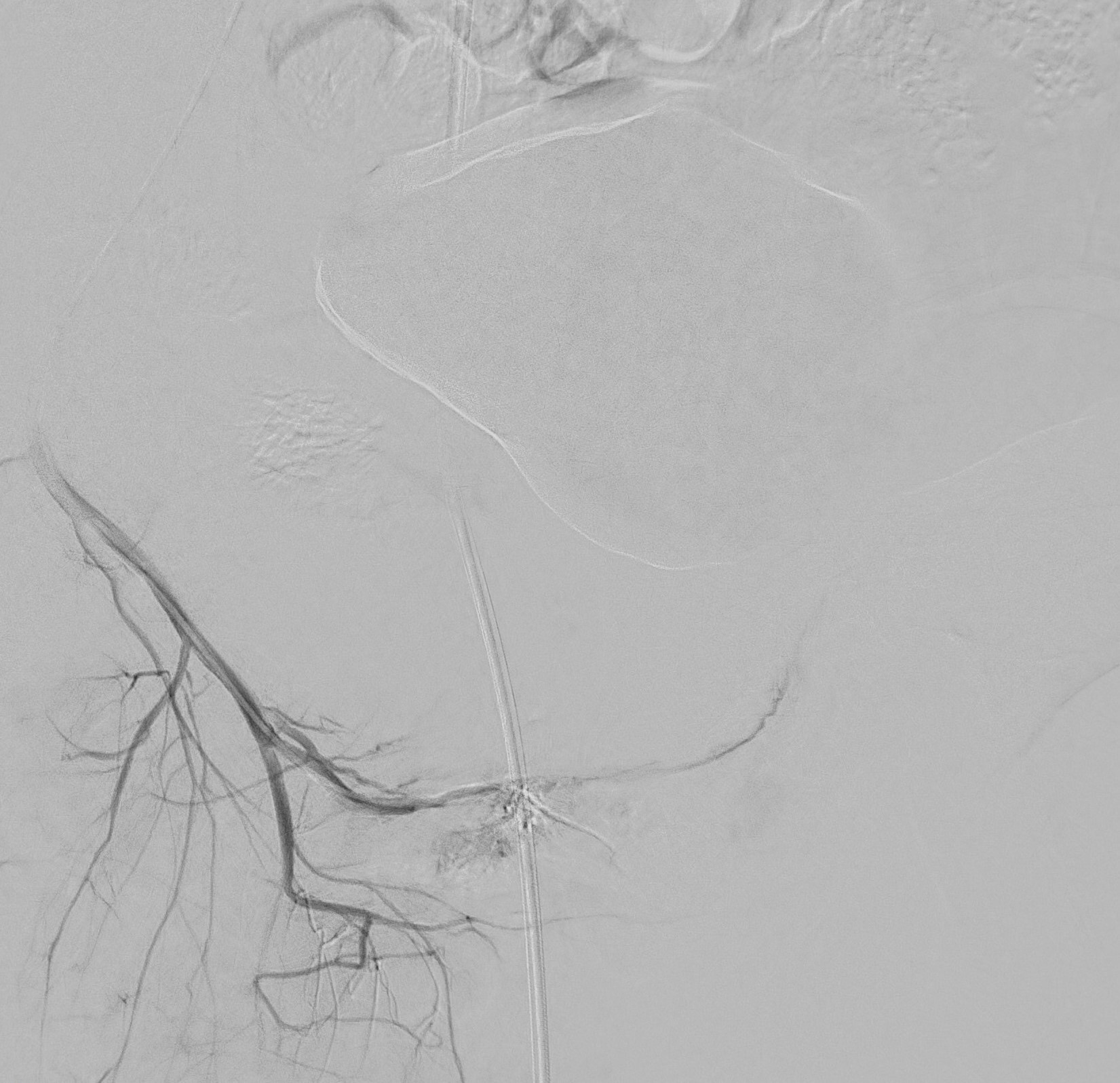 Second non-permanent embolization with
Spongostan® of the same fistula.