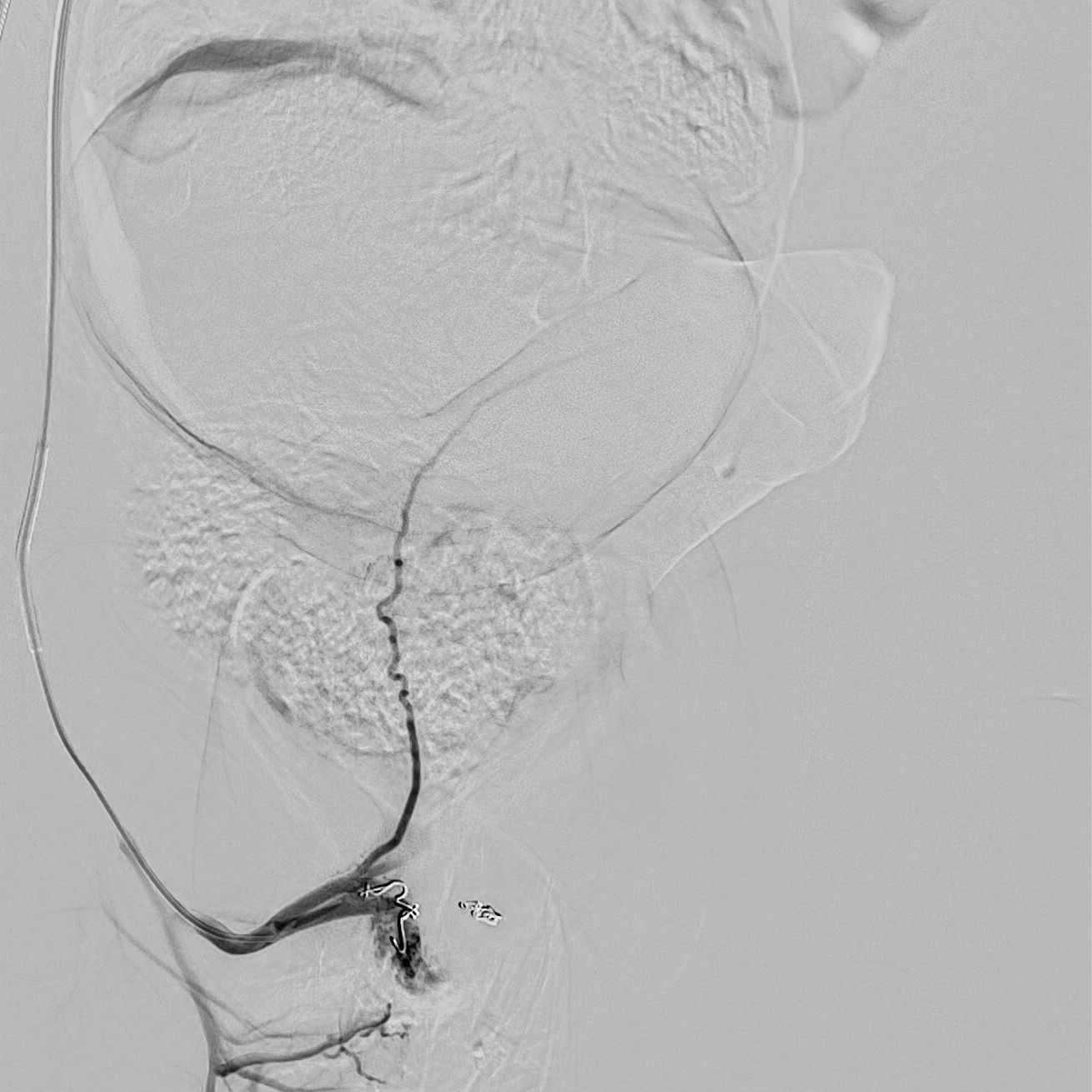 Embolization with non-absorbable coils.