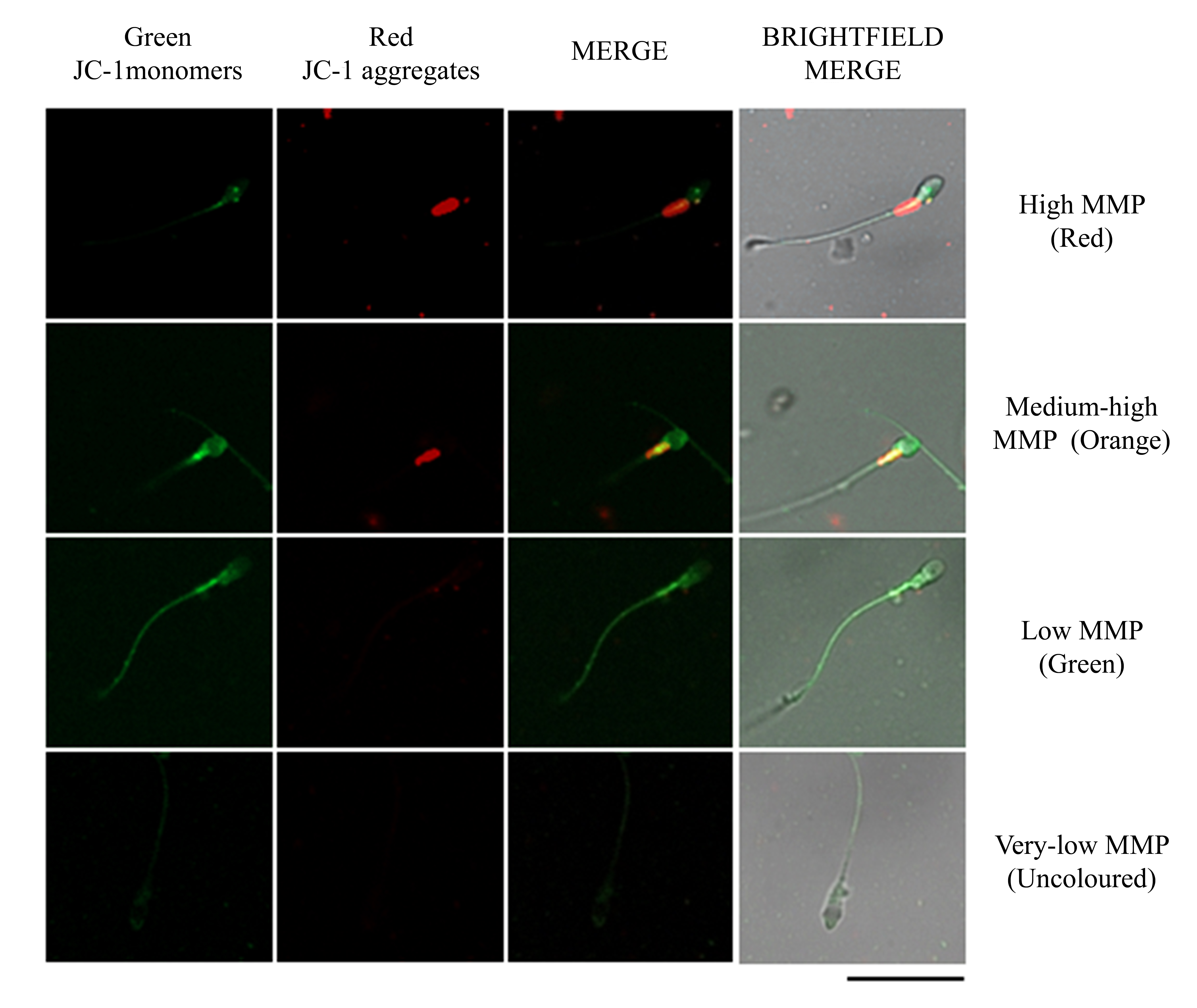 Fluorescent micrographs of mitochondrial membrane potential
assay in human sperm. High mitochondrial membrane potential sperm (red),
medium-high mitochondrial membrane potential sperm (orange), low mitochondrial
membrane potential sperm (green), and very low mitochondrial membrane potential
sperm (no fluorescence). Scale bar: 20 μm. JC-1:
5,5′,6,6′-tetrachloro-1,1′,3,3′-tetraethylbenzimidazolcarbocyanine
iodide; MMP: Mitochondrial membrane potential.