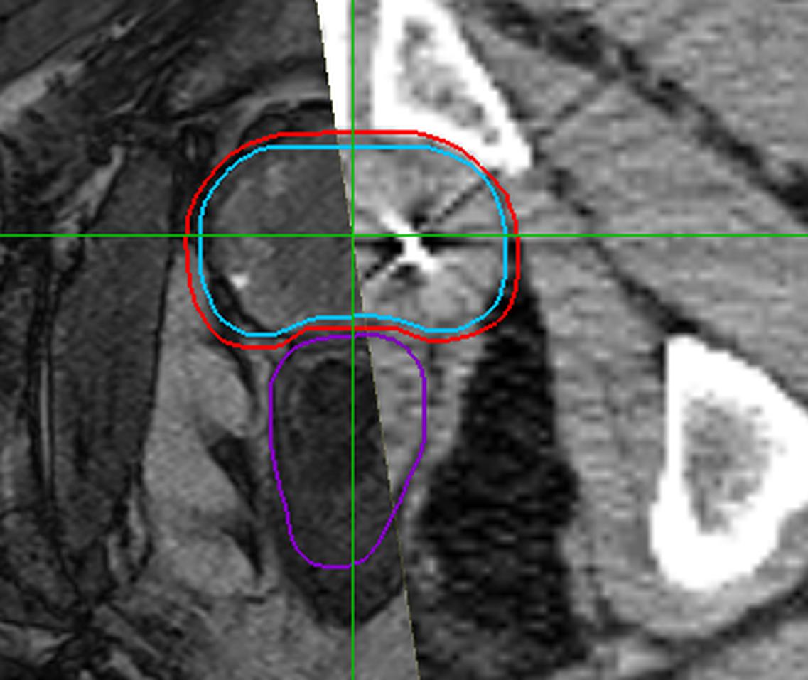 MRI-CT fusion for accurate contouring.