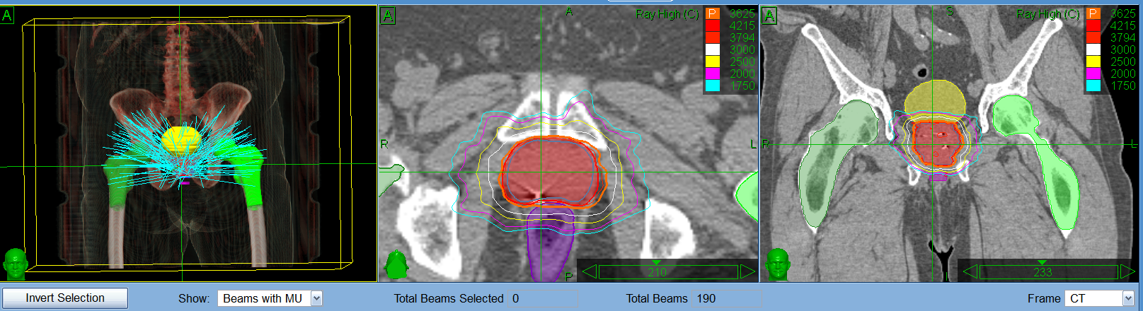 Beam delivery to the PTV through Cyberknife. CT: computed
tomography; MU: Monitor Units.