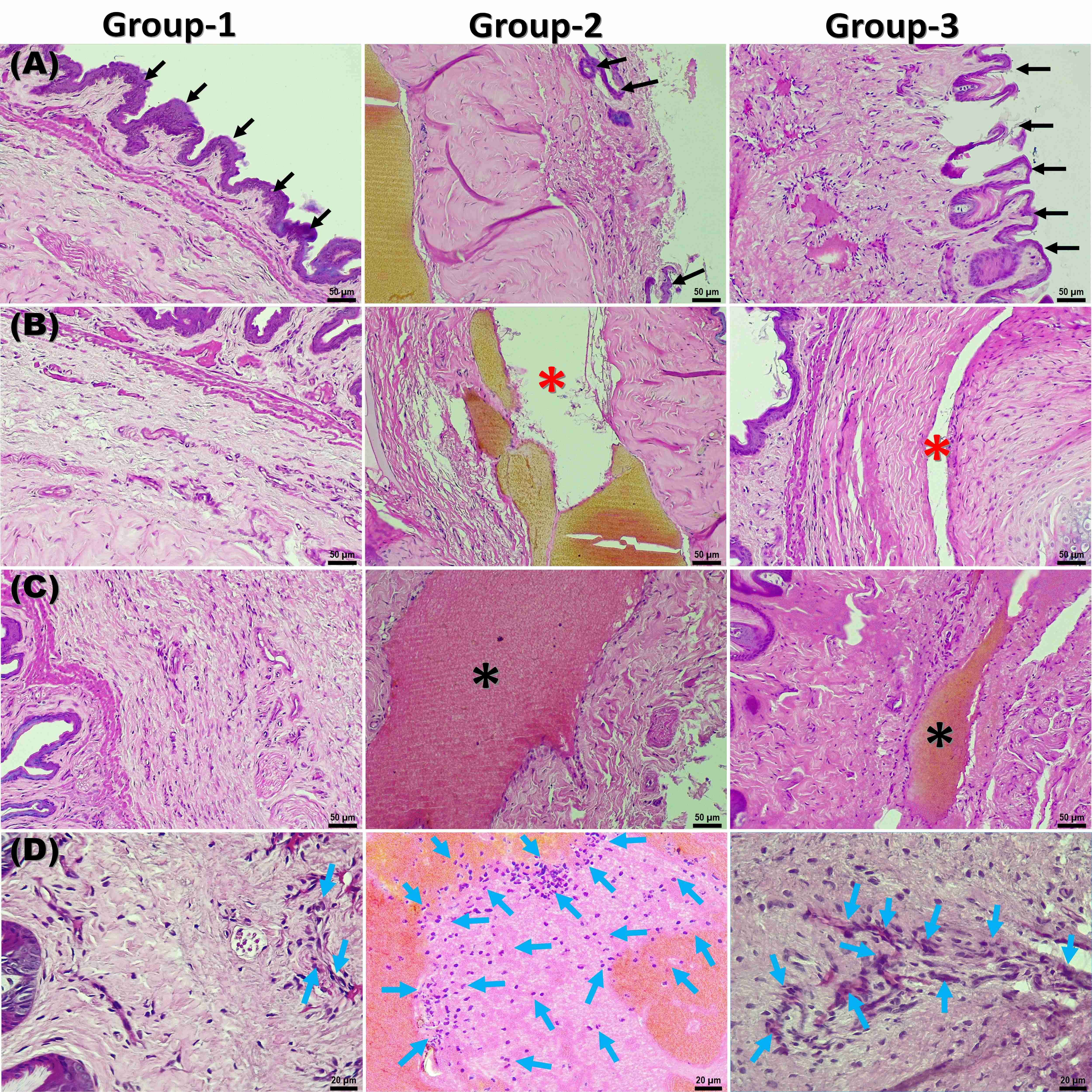 Representative microscopic images of hematoxylin-eosin-stained
penile tissues from the study groups. (A) Evaluation of desquamation (black arrows: epithelium). In Group 1, the
epithelium shows normal thickness. In Group 2, severe desquamation is observed,
with very few areas showing intact epithelium. Group 3 shows reduced epithelial
thickness with mild desquamation. (B) Comparison of edema (red stars: areas of
edema). No edema is observed in Group 1. Group 2 shows marked and diffuse edema.
Group 3 exhibits mild edema. (C) Comparison of vasocongestion and haemorrhage
(black star: haemorrhagic and vasocongestion areas). Group 1 shows normal stromal
areas with vascular structures of normal caliber. In Group 2, intense
vasocongestion and severe hemorrhagic area are observed. Group 3 exhibits
moderate vasocongestion and hemorrhagic areas. (D) Comparison of inflammation
(blue arrow: areas of inflammatory cell infiltration). In Group 1, inflammatory
cell infiltration is minimal to negligible. Group 2 displays areas of intense
inflammatory cell infiltration. Group 3 shows mild to moderate levels of
inflammatory cell infiltration. (Scale bars: 50 µm for A–C; 20
µm for D).
