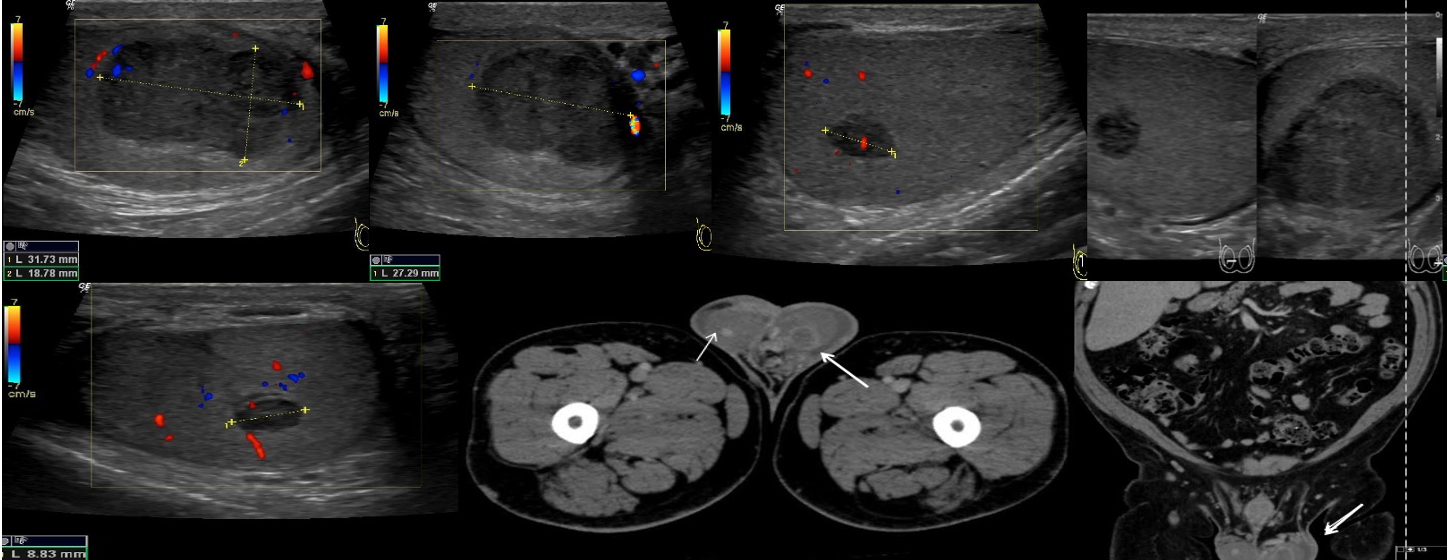 Ultrasound images demonstrating bilateral hypoechoic nodules,
while axial and coronal CT scans reveal bilateral testicular nodules.