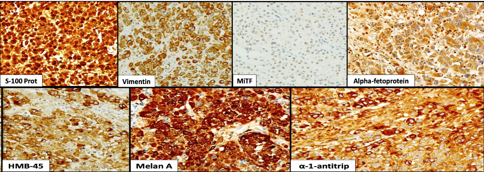 Immunohistochemical analysis (400×). MiTF:
Microphthalmia-associated transcription factor; HMB-45: Human Melanoma Black-45.