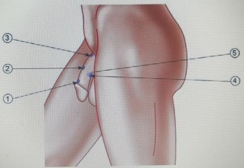 Penile anatomical points in Li-ESWT. The tip, middle and lower
parts of the dorsal side are shown in the ①, ② and ③
numbers. Both lateral sides of the penis are shown in the ④ and
⑤ numbers.