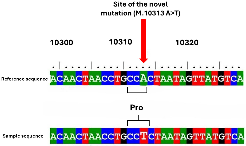 Alignment of the
MT-ND3 reference gene sequence (NC_012920.1) with the sample sequence
showing the synonymous mutation 10313 A>T. The red arrow indicates the site of
the nucleotide substitution.
