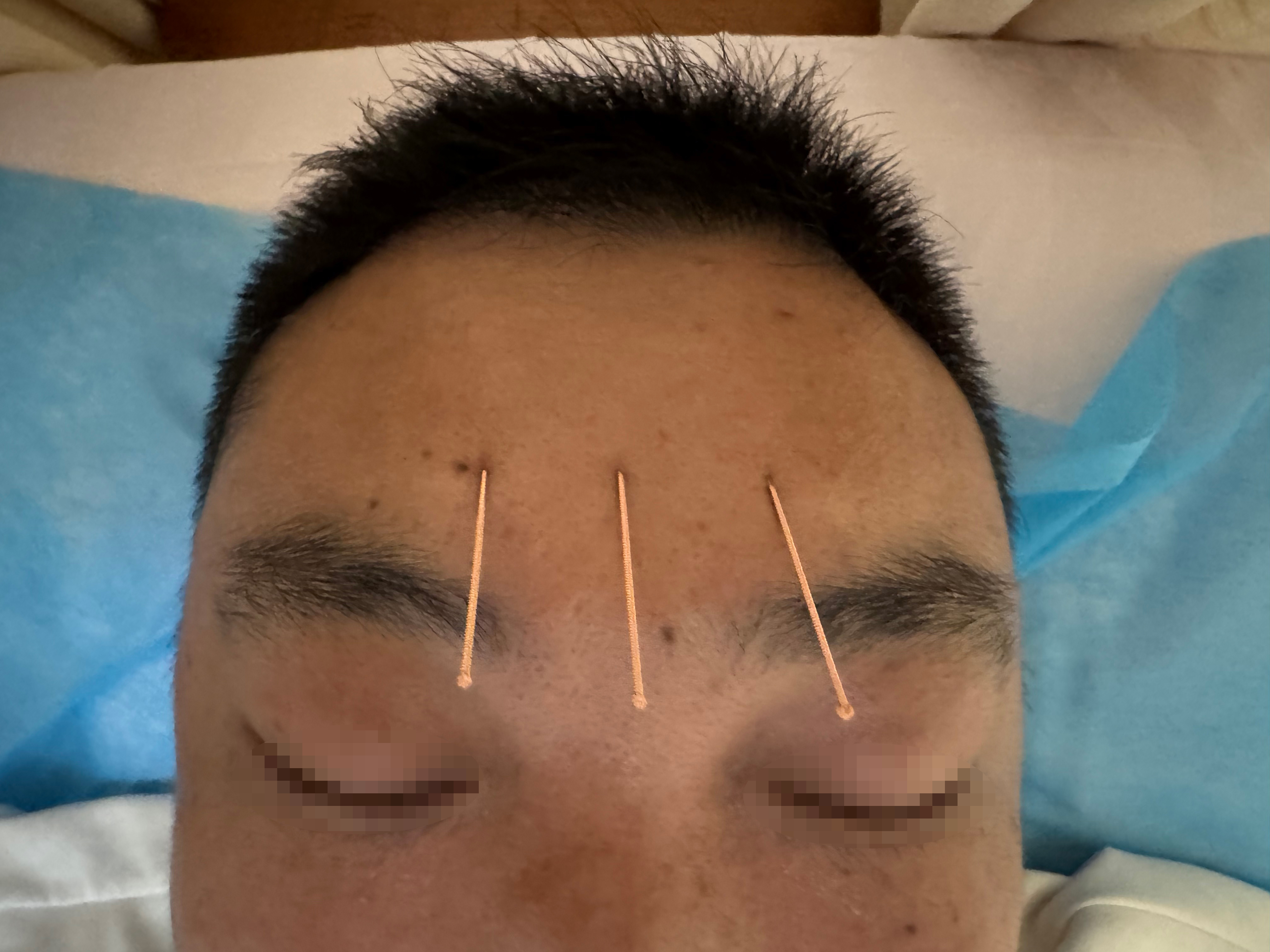 rTAS protocol: scalp mapping and needling sites.