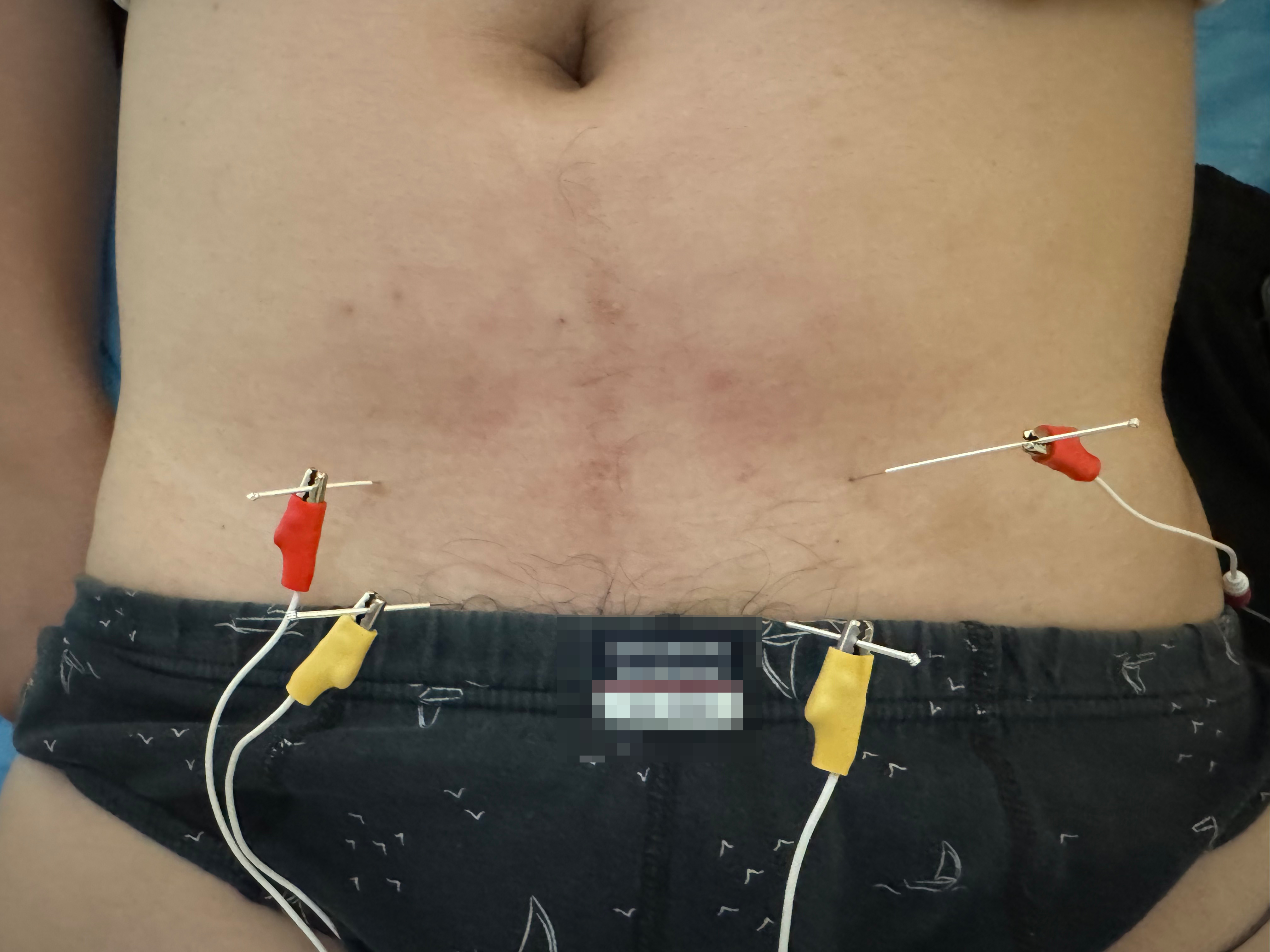 PNEA protocol: anatomical landmarks and needle path.