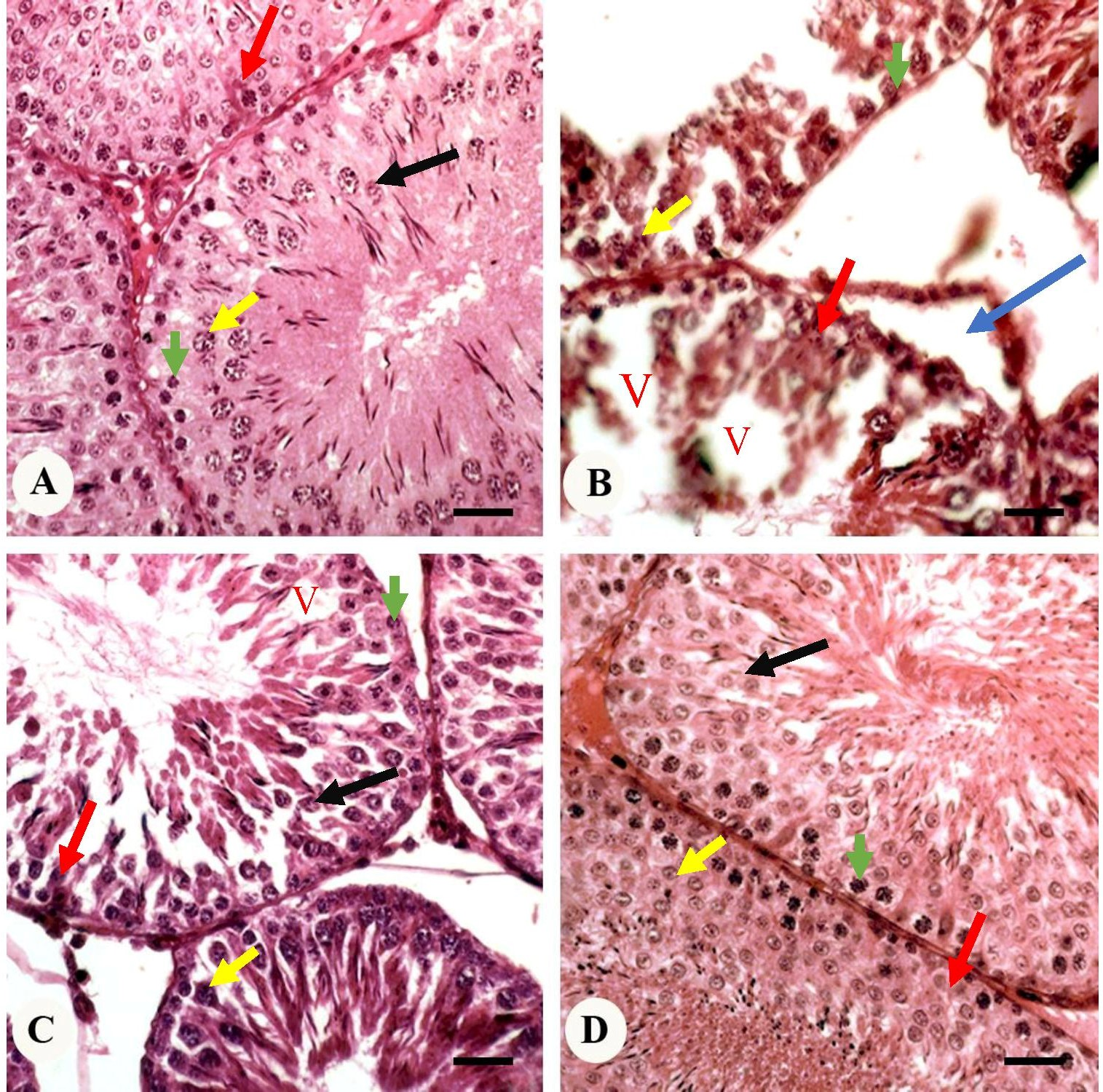 Histological finding in study groups. (A) Sham group showing
typical testicular structure. (B) Varicocele group displaying severe testicular
damage: arrows indicate atrophied seminiferous tubules, vacuolization (V), and
sloughed germ cells (arrowheads). (C) Varicocele + Minocycline group indicating
improvement in seminiferous tubule structure. (D) Minocycline group exhibiting
normal testicular structure. Scale bar: 50 μm. Blue arrows indicate
atrophied seminiferous tubules, vacuolization (V), and red arrowheads Sertoli
cells, green arrowheads Spermatogonia cells, yellow arrowheads Primary
Spermatocytes cells, Black arrowheads Round Spermatids cells. Scale bar: 50
μm.
