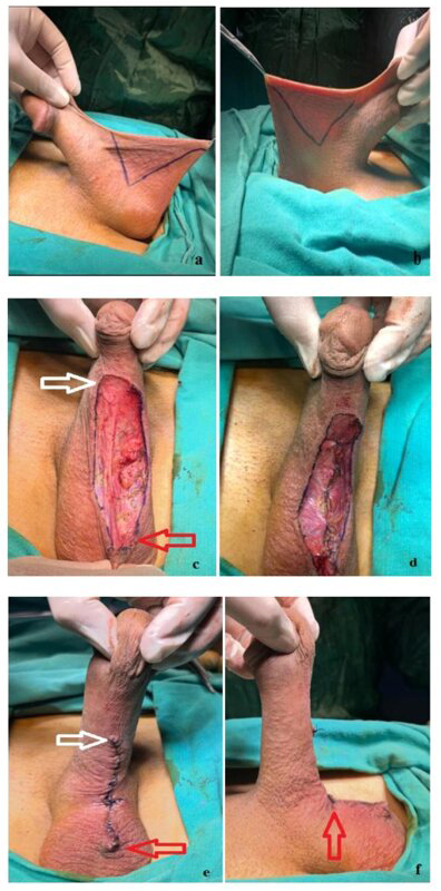 Steps of ventral phalloplasty surgery. (a,b) V-shaped mark on
the tissue to be removed. (c) The appearance of tissue removed without damaging
the tunica vaginalis and the underlying dartos fascia. (d,e) Image showing
closure of skin and subcutaneous tissues with monofilament absorbable sutures.
(f) Satisfactory cosmetic and functional finish.