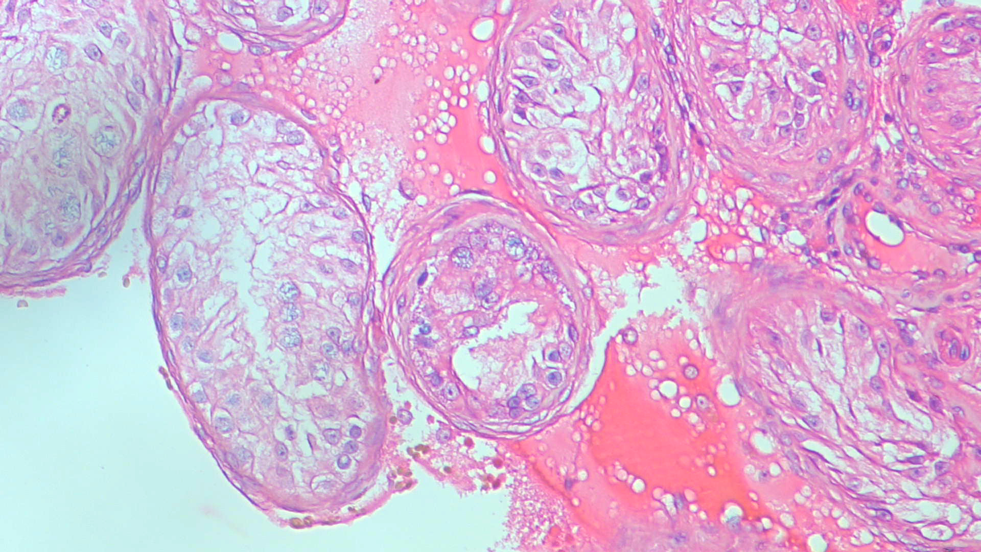 Testicular histopathology obtained at right-sided micro-TESE.
The majority of seminiferous tubules show a Sertoli cell-only pattern with
reduced tubular diameter and absence of germ cells (mean Johnsen score 2); a
minority of focally dilated tubules contain spermatocytes and early spermatids,
consistent with focal residual spermatogenesis and representing the
intraoperative target of microdissection. This mixed-atrophy pattern is
compatible with partial preservation of the proximal AZFb region (sY105 and sY121
retained). Haematoxylin and eosin; original magnification ×200.